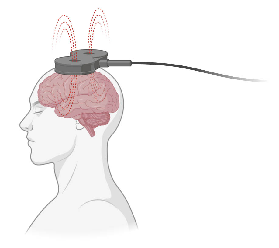 neuromodulacion, estimulacionn, magnetica, transcraneal